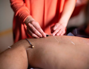 Person receiving acupuncture treatment on back.